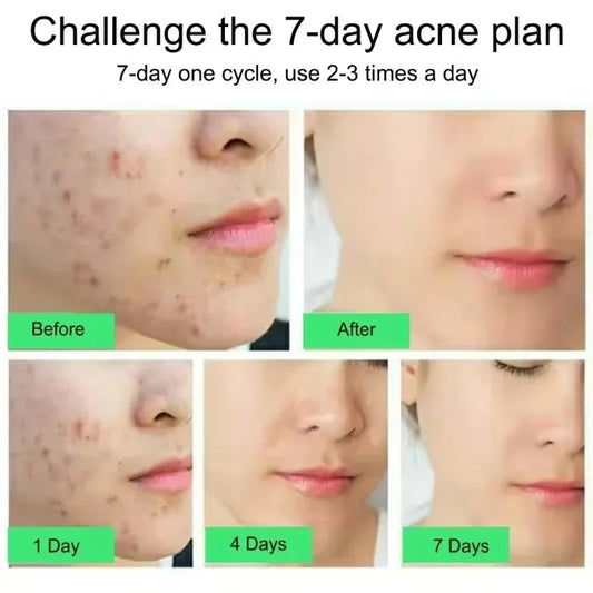 Acid Acne Treatment Face Cream