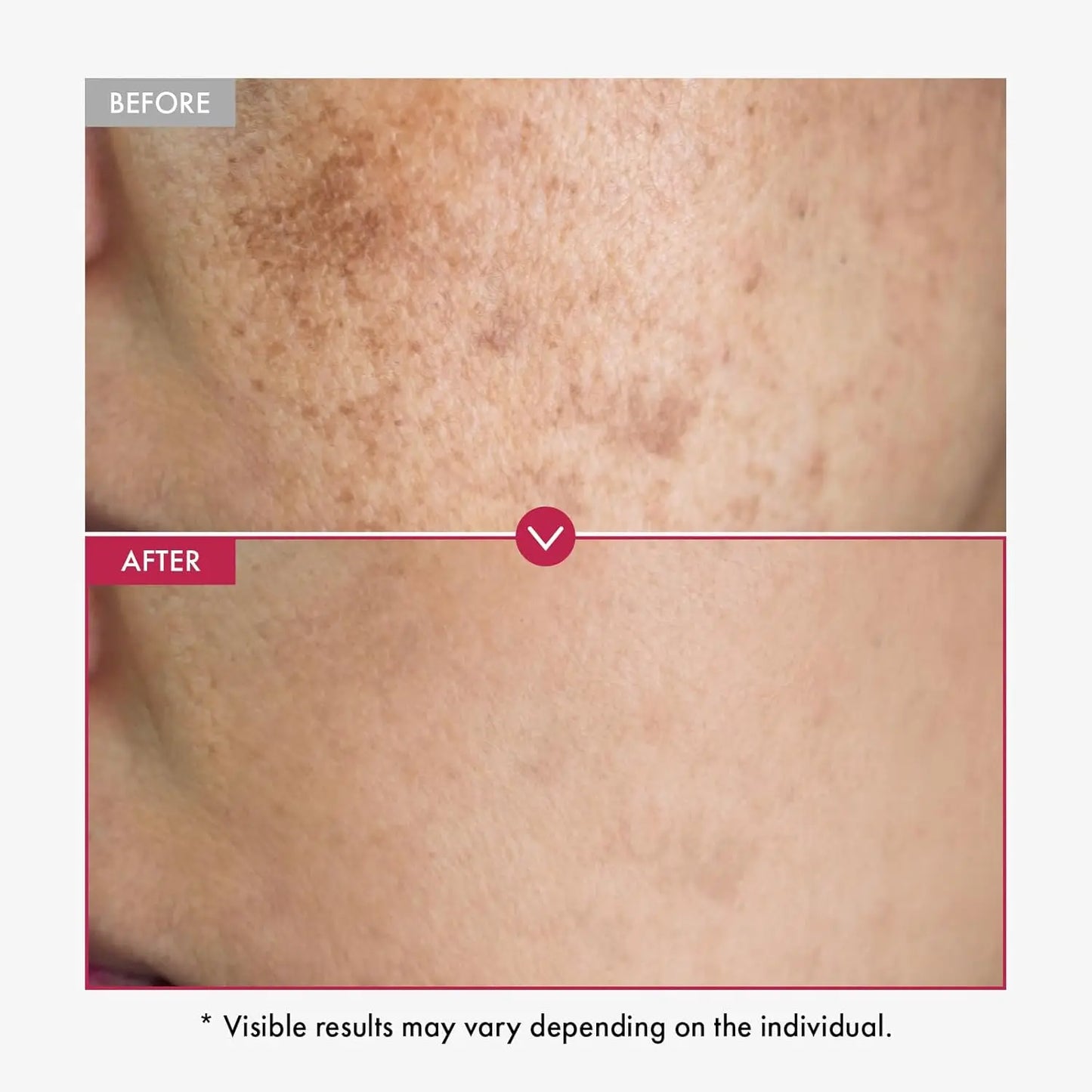 Suero corporal de alfa arbutina