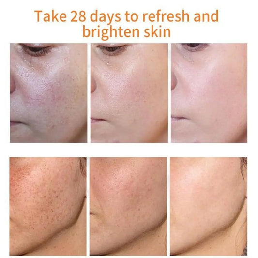 Whitening Freckles Cream Remove Dark Spot