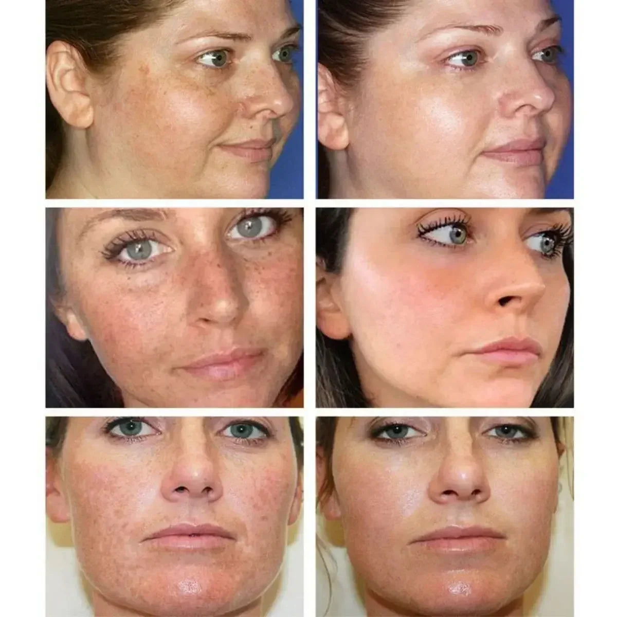 Whitening Freckles Cream Remove Dark Spot