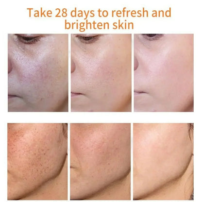 Whitening Freckles Cream Remove Dark Spot