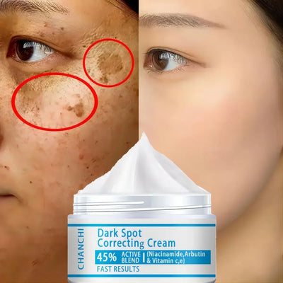 Whitening Freckles Cream Remove Dark Spot