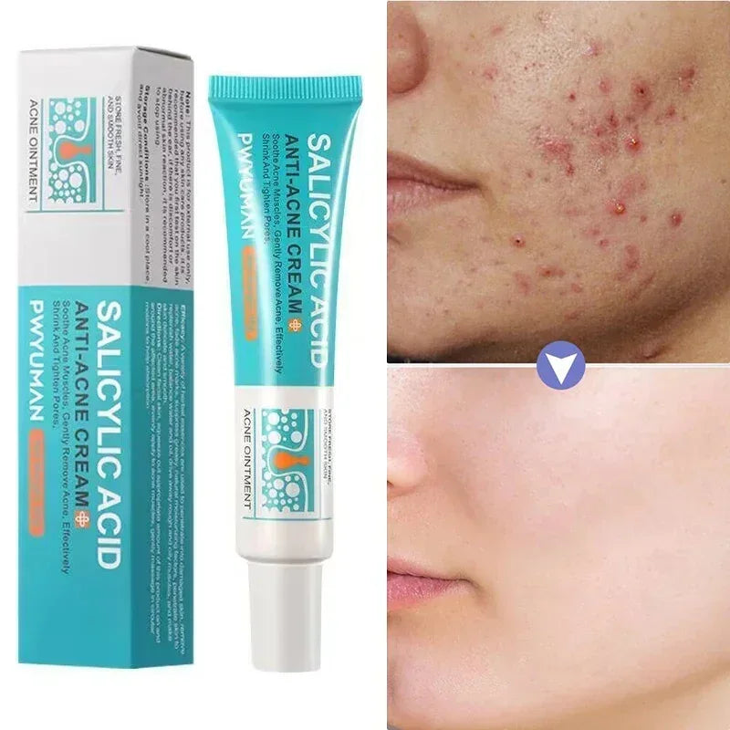 Crema facial para el tratamiento del acné ácido