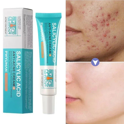 Crema facial para el tratamiento del acné ácido