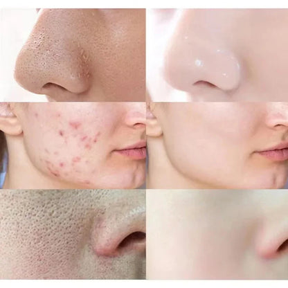 Volcano Cleansing Blackhead Remover Mask