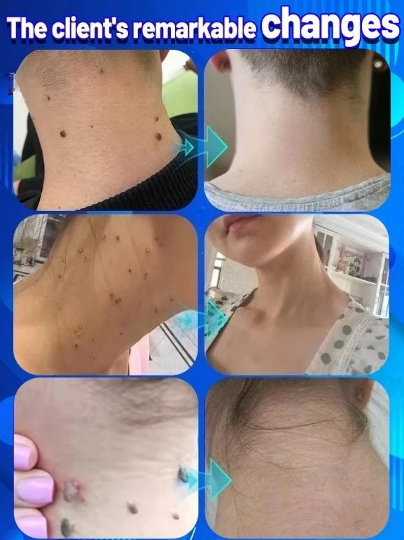 Wart Remover Pᴇɴ Efficient Removal Skin Care